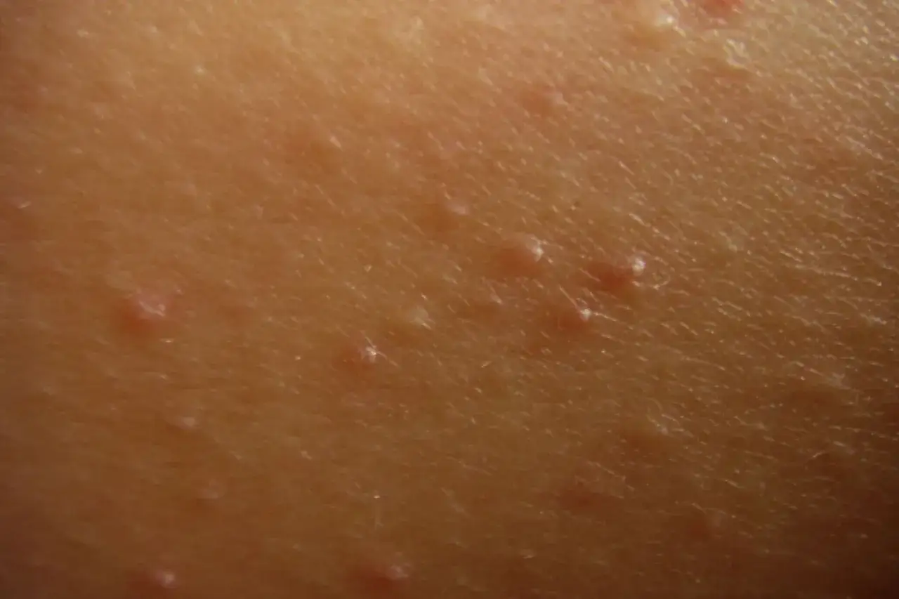 Närbild på hud med små, upphöjda prickar, typiskt för keratosis pilaris hos barn.