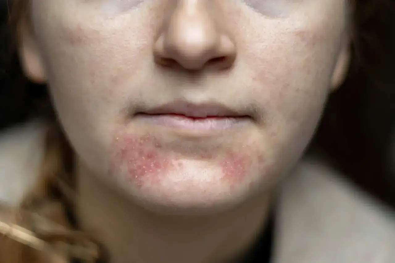 Närbild på en kvinna med rodnad och utslag runt munnen, möjligtvis perioral dermatit kopplat till klimakteriet.