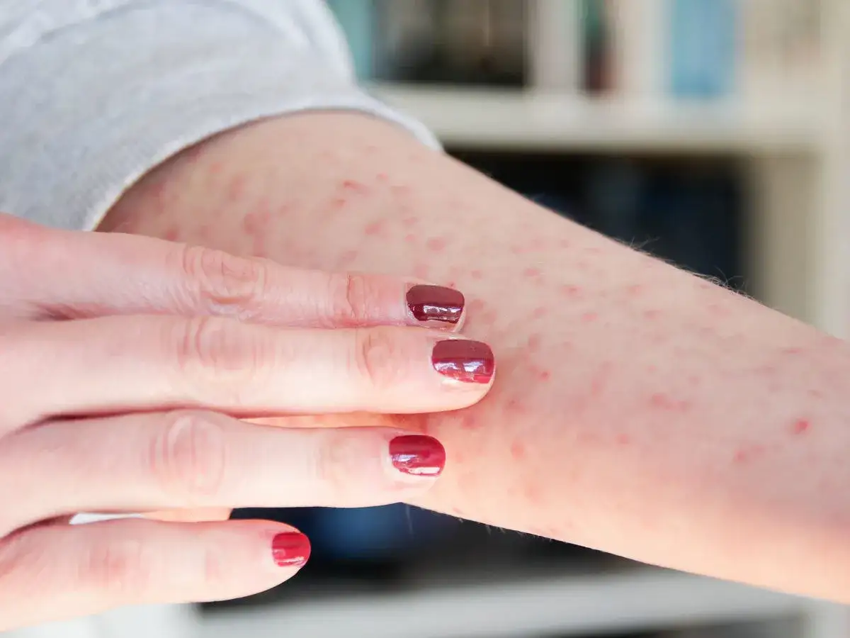 En arm med många små, röda prickar. En hand med mörkrött nagellack undersöker huden.