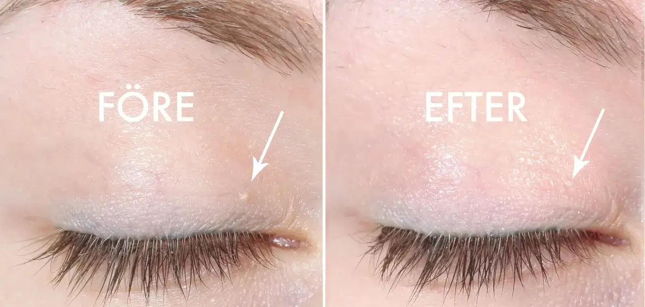 Före och efter-bild som visar hur man kan ta bort milier hemma. En liten vit prick under ögat är borta.
